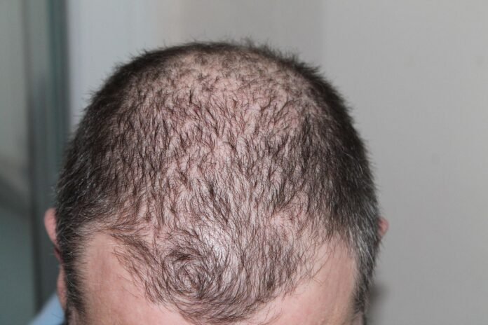 homen mostrando a sua queda de cabelo.